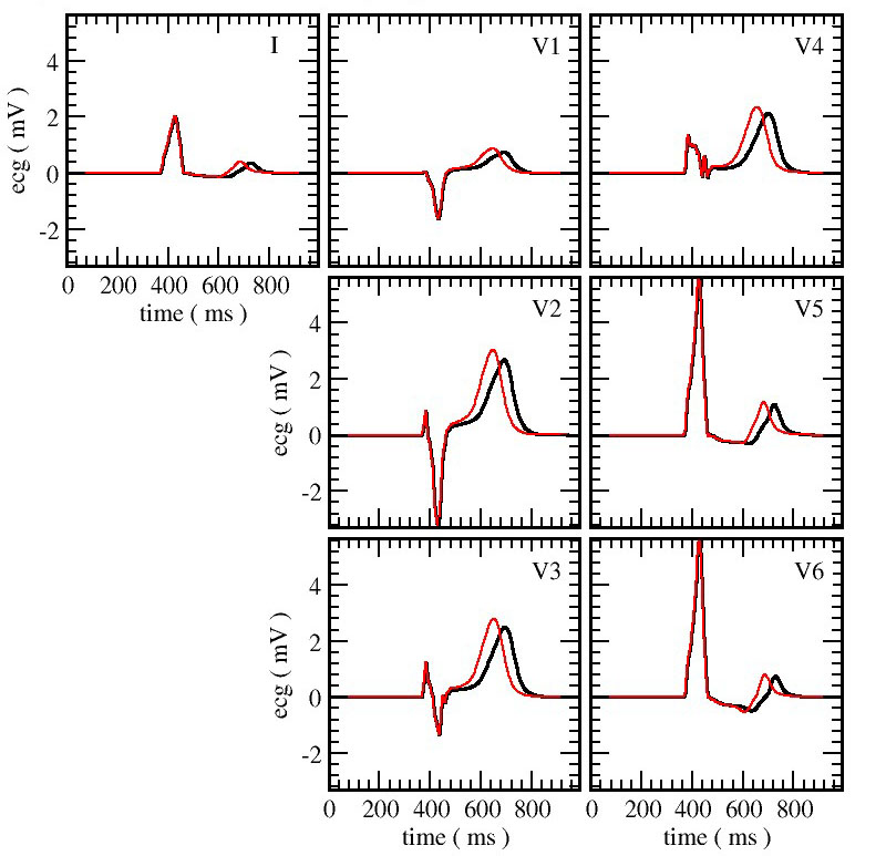 Figure5.Electrocardiogramsshowthatthepresenceofranolazineincreasesthetimeittakesforaheartbearttocomplete(black)comparedtothecontrol(red).