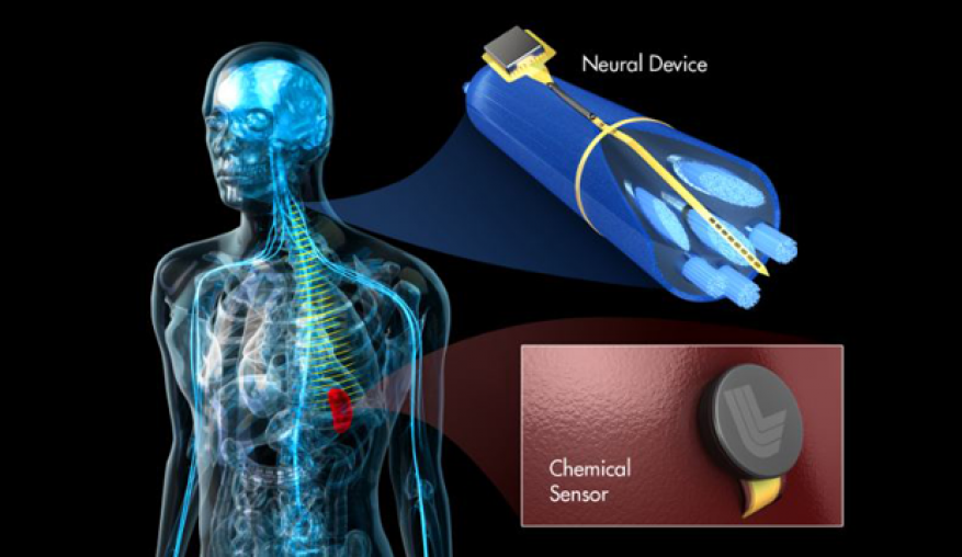 Peripheral Nerve Stimulators Medical Devices Pipeline Product Analysis Simultaneous Peripheral Nerve Stimulation and Gastrointestinal System